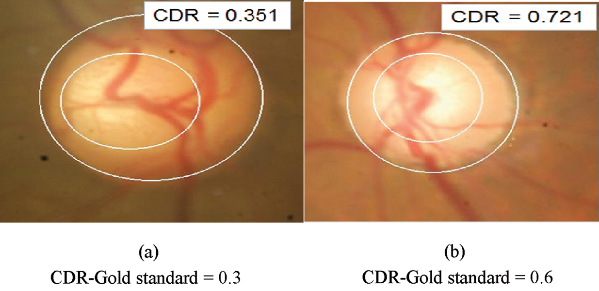 Images Molecular Cellular Biomechanics Images Doi 10 32604 Mcb 2021 014622 Article Determination Of Cup To Disc Ratio Using Unsupervised Machine Learning Techniques For Glaucoma Detection R Praveena And T R Ganeshbabu