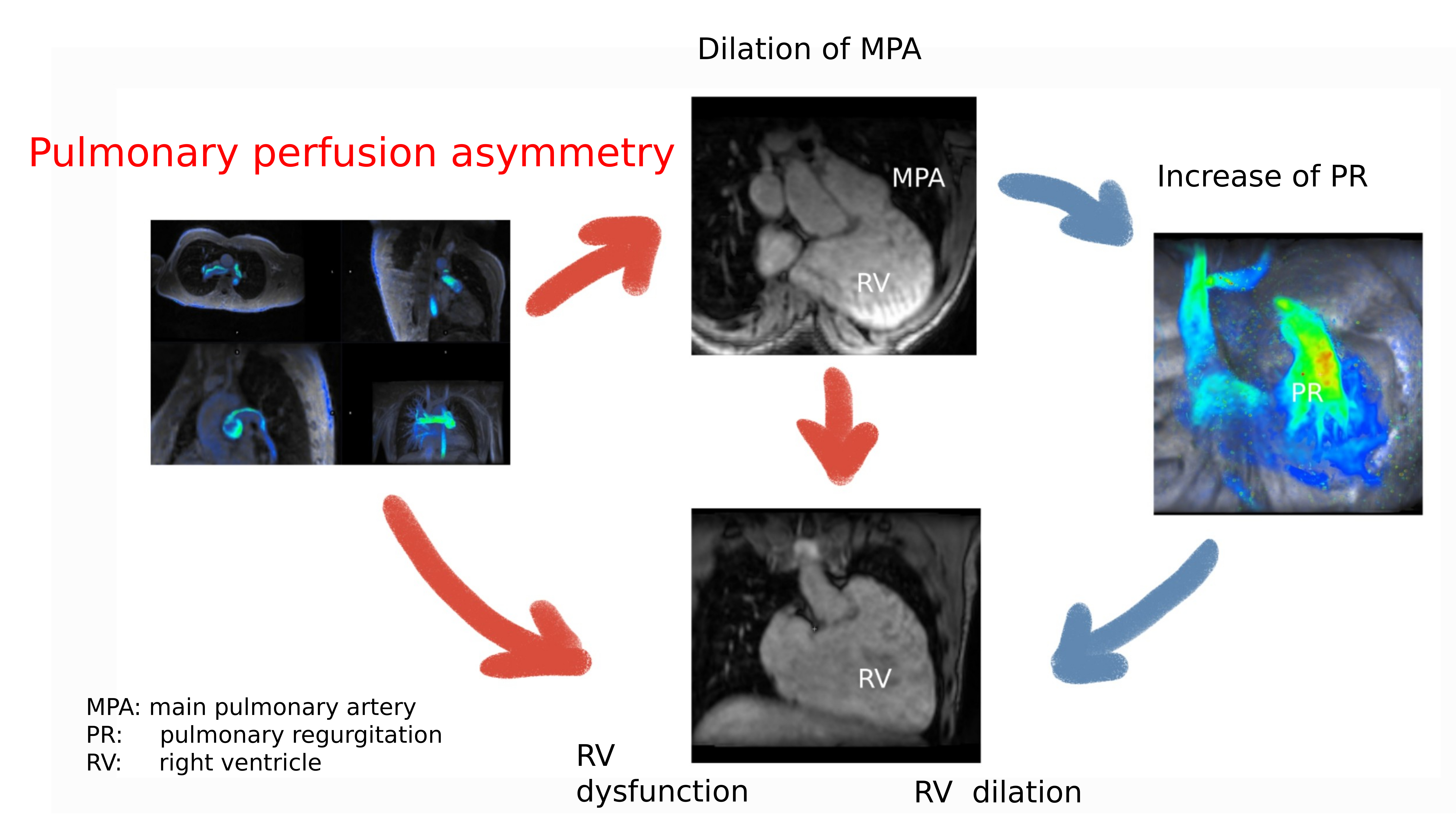 Pulmonary Perfusion Asymmetry in Patients after Repair of Tetralogy of Fallot: A 4D Flow MRI-Based Study